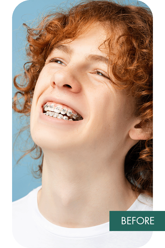 no braces filter comparison